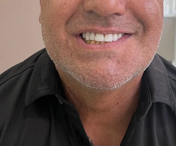 Después del diseño de sonrisa en Pereira, caso 1