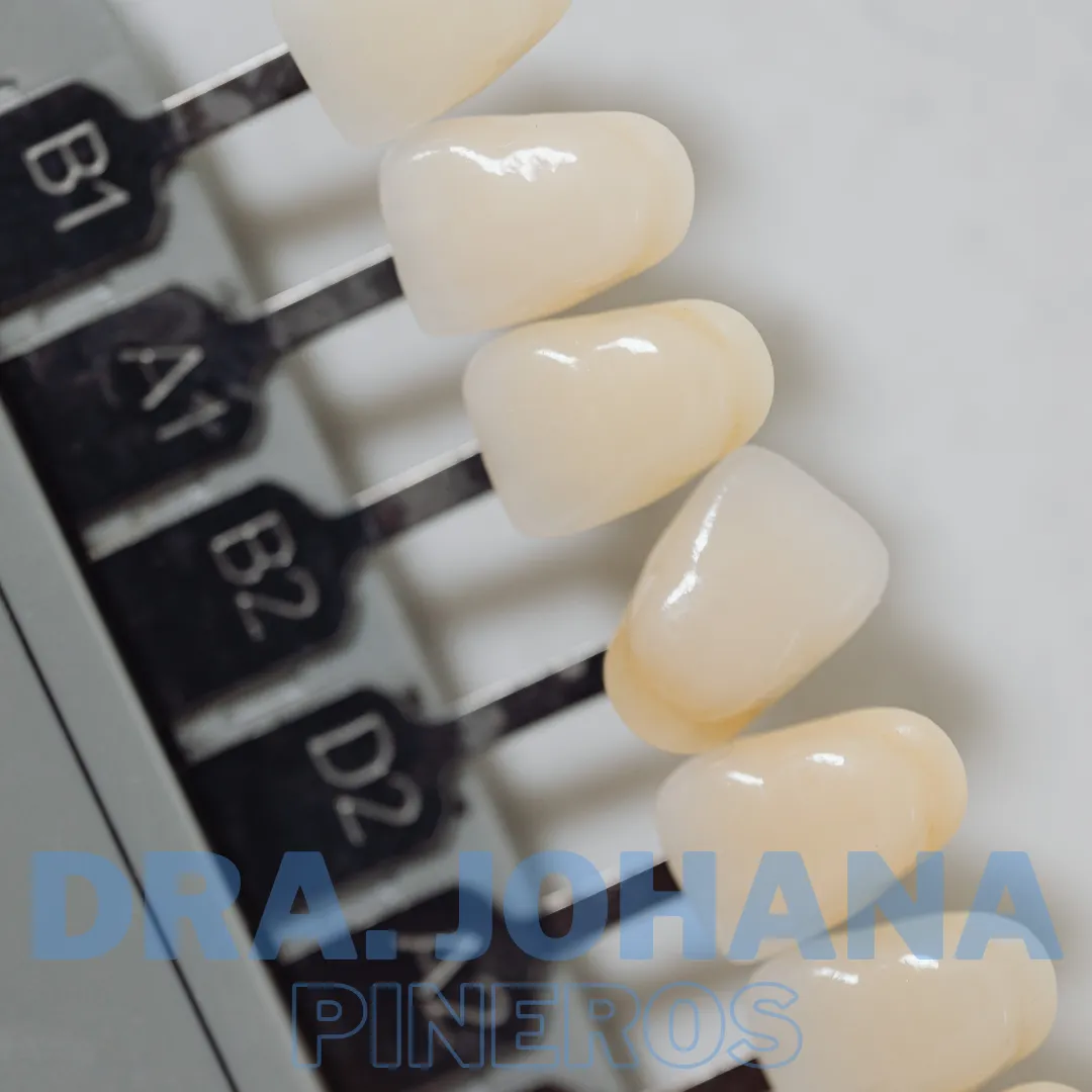 Guía de color dental usada para medir el resultado del blanqueamiento en Pereira