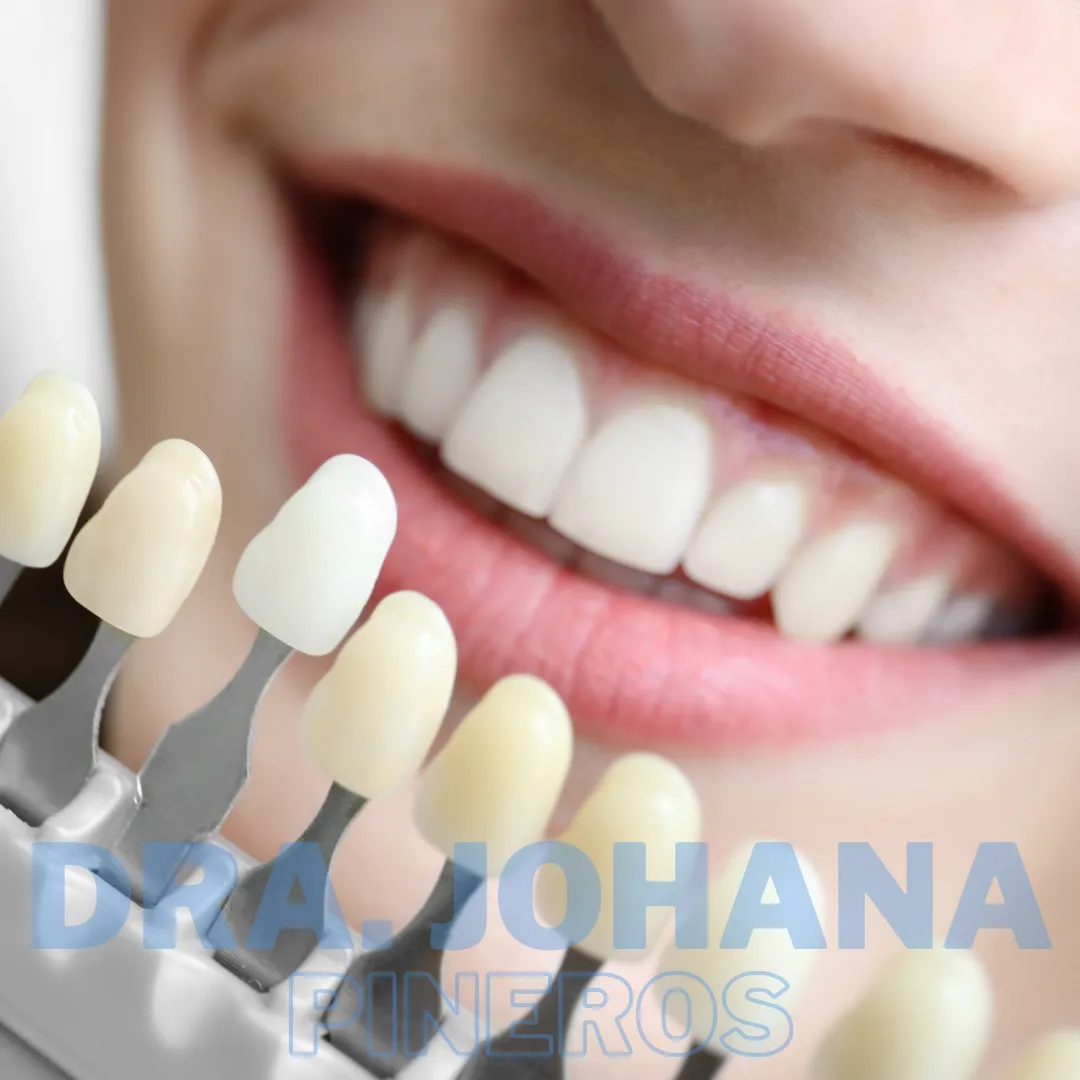 Selección del color de una corona dental para que combine con tus dientes naturales en Pereira