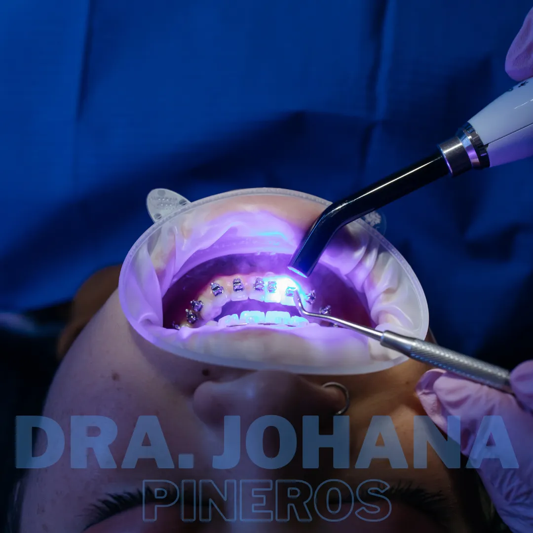 Procedimiento de blanqueamiento dental en Pereira