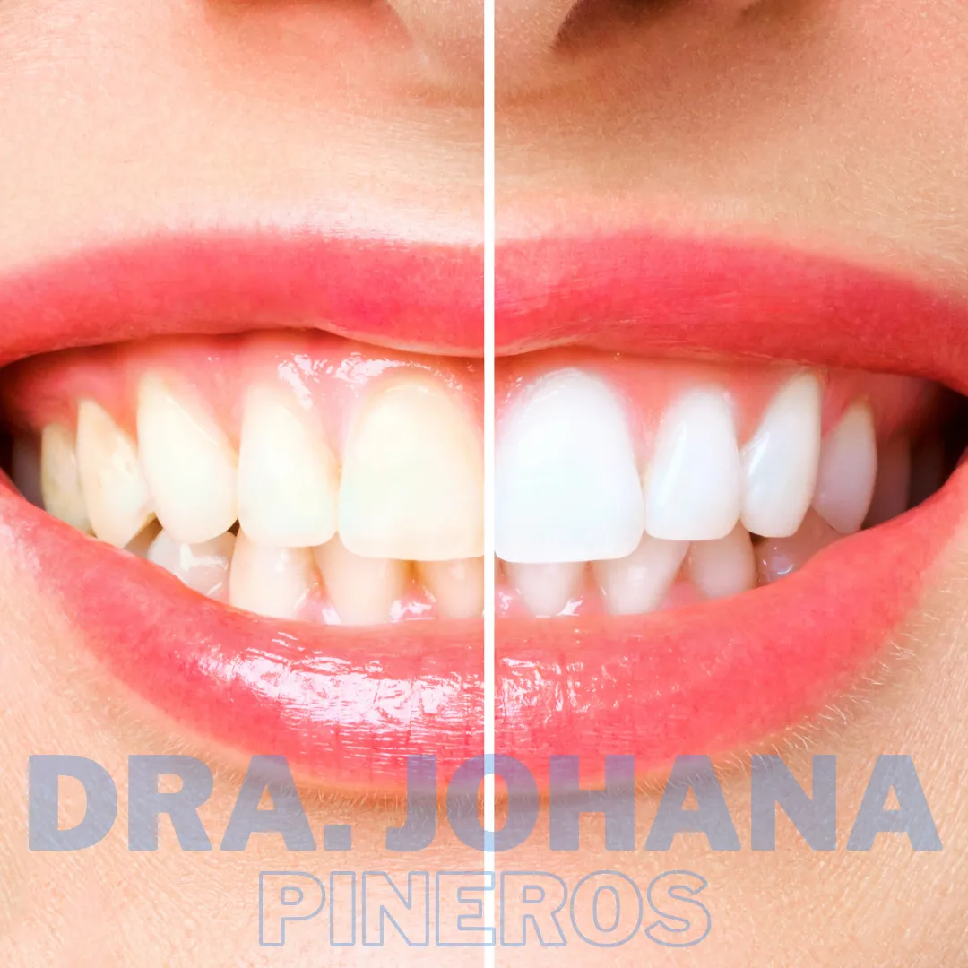 Resultado de blanqueamiento dental en Pereira