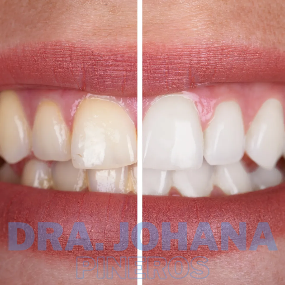 Resultado de blanqueamiento dental en Pereira, caso 2
