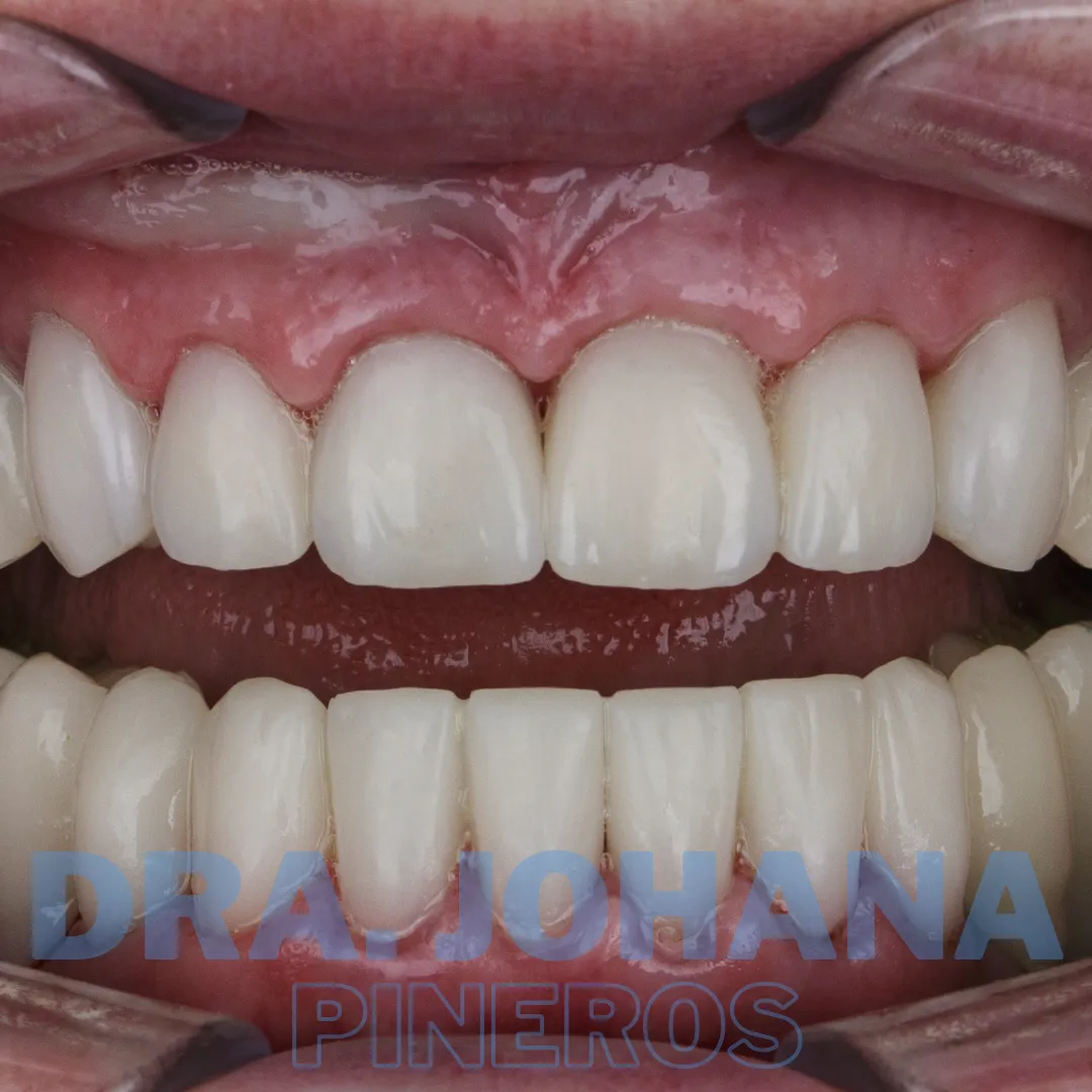 Sonrisa estética saludable lograda en Pereira