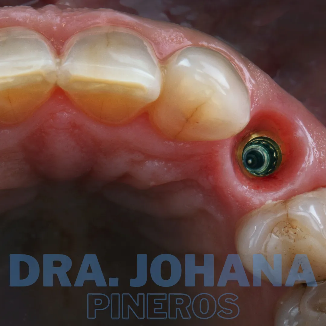 Implante dental cicatrizado en la encía