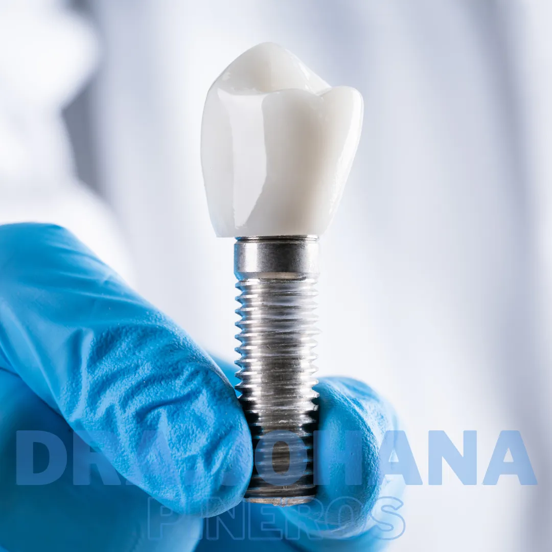 Modelo de implante dental utilizado en Pereira