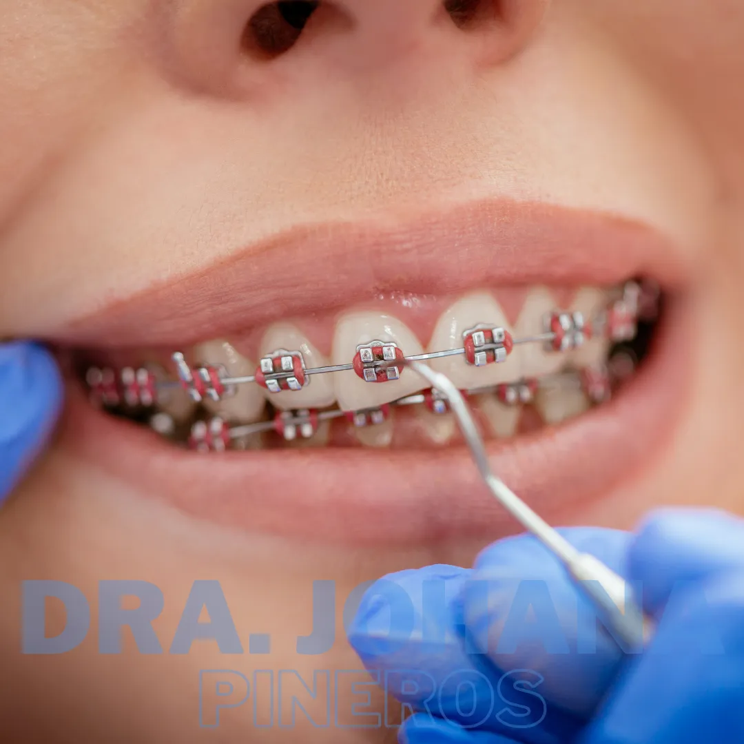 Brackets metálicos con ligas de color en Pereira