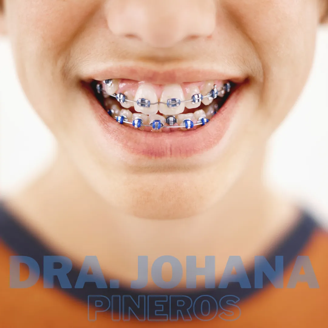 Paciente con brackets metálicos sonriendo en Pereira