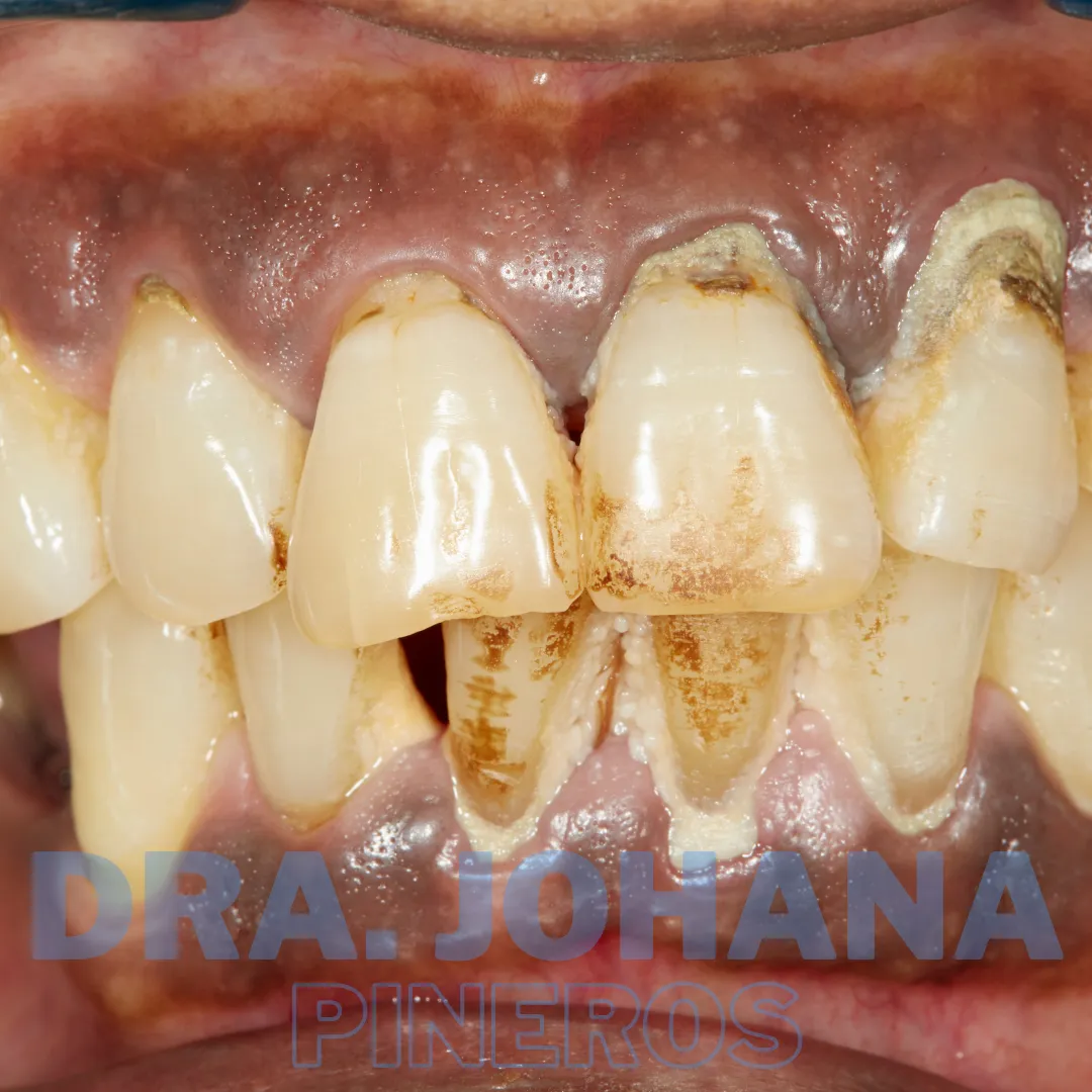 Periodoncista en Pereira: Qué Hace y Cuándo Debes Consultar a Uno