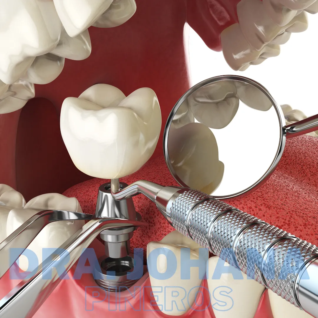 Implantes dentales en Pereira