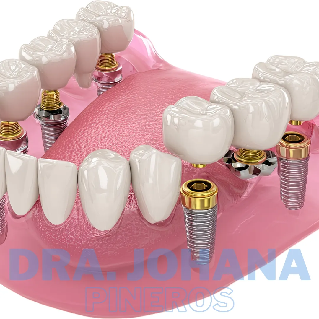 Puente sobre implantes, rehabilitación oral en Pereira
